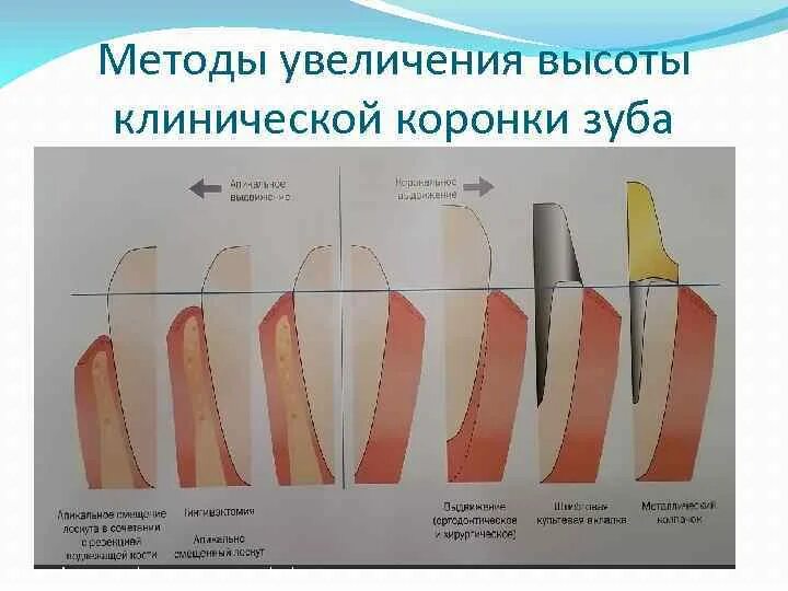 Какую функцию выполняет коронка зуба. Методы увеличения клинической высоты коронки зуба. Анатомическая и клиническая коронка зуба. Хирургическое удлинение клинической коронки зуба. Клиническая коронка зуба это.