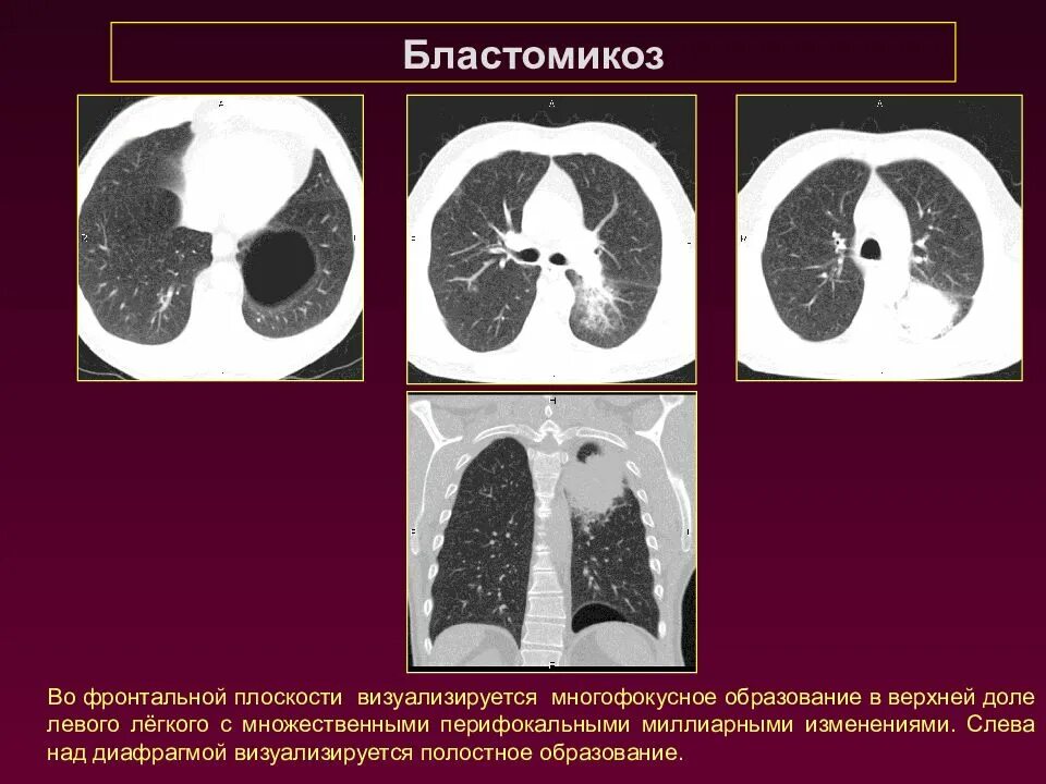 Полостное образование легкого кт. Полостные образования в легких на кт. Полостное образование в легком на кт. Образование верхней доли левого легкого