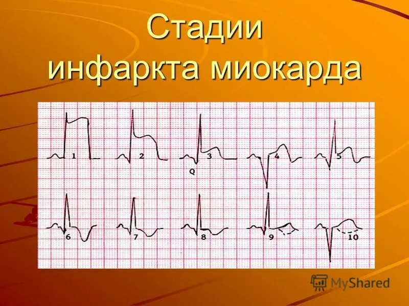 Подострая стадия инфаркта миокарда на экг. Кардиосклероз гистология. Острейшая стадия инфаркта миокарда экг. Признаки острейшей фазы инфаркта миокарда на экг. Стадия рубцевания на экг.
