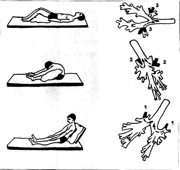 Как делать массаж отхождение мокроты. Постуральный дренаж при бронхиальной астме. Постуральный дренаж бронхов. Постуральный дренаж и гимнастика. Постуральный дренаж при пневмонии.