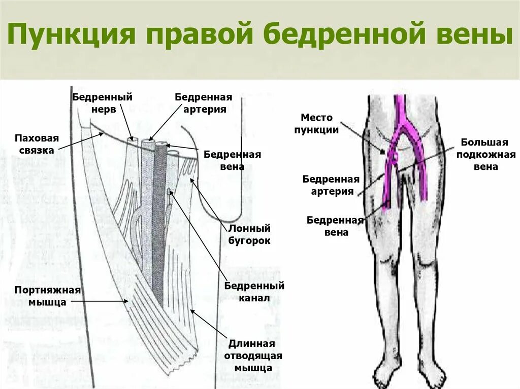 Бедренная Вена топография. Пункция бедренной вены схема. Проекция бедренной вены. Пликация поверхностной бедренной вены.