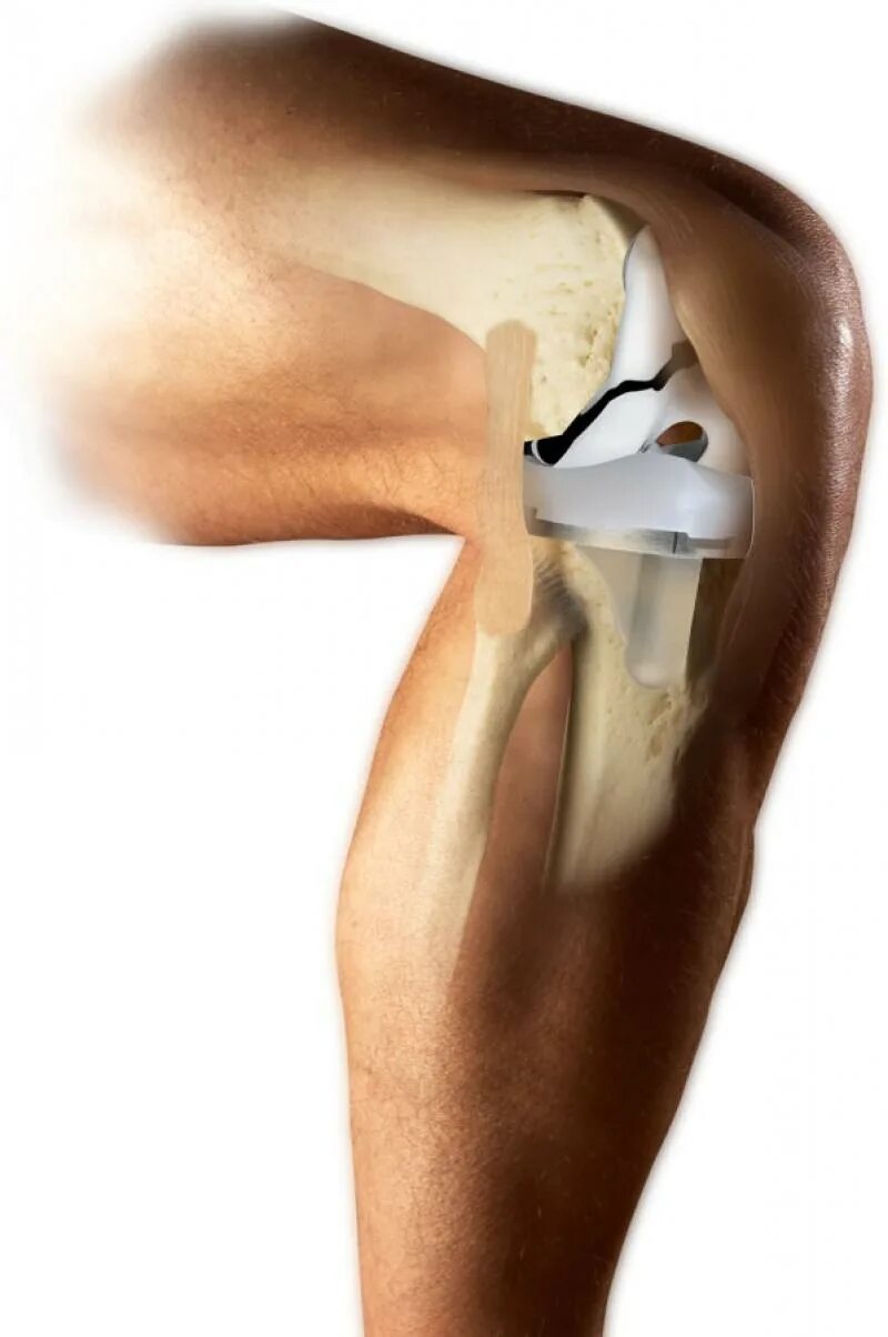 Эндопротез коленного сустава. Эндопротез Triathlon. Титановый эндопротез коленный.