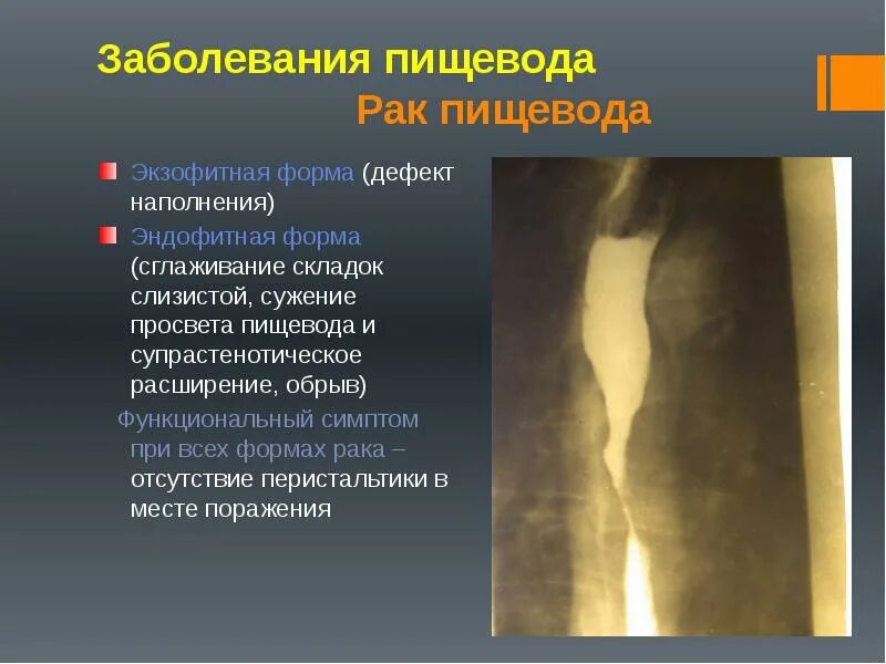 Расширение просвета пищевода. Супрастенотическое расширение пищевода. Супрастенотическое расширение пищевода рентген. Дефект наполнения пищевода.