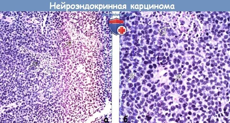 Нейроэндокринная опухоль поджелудочной железы. Нейроэндокринная опухоль поджелудочной железы кт. Опухоль крючковидного отростка поджелудочной железы кт. Нейроэндокринная опухоль поджелудочной железы. Нейроэндокринная опухоль печени.