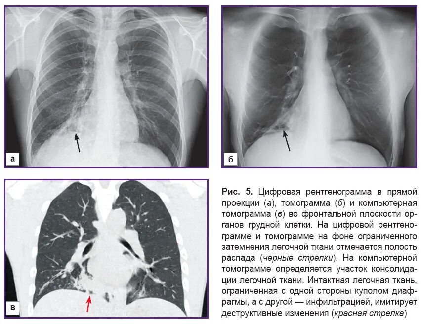 кт лёгких и бронхов. компьютерная томография органов грудной клетки. линейная томограмма легких туберкулез. пневмония на кт огк. кт грудной клетки результат.