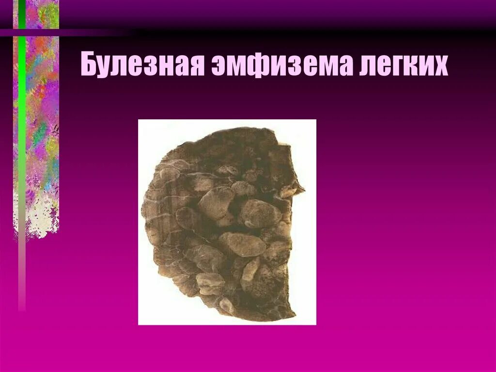 Вылечить эмфизему легких