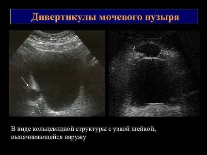 Дивертикул мочевого пузыря что это