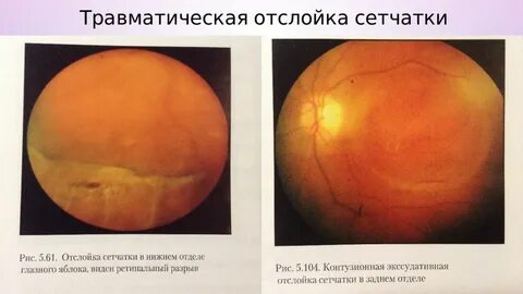 Виды отслойки сетчатки