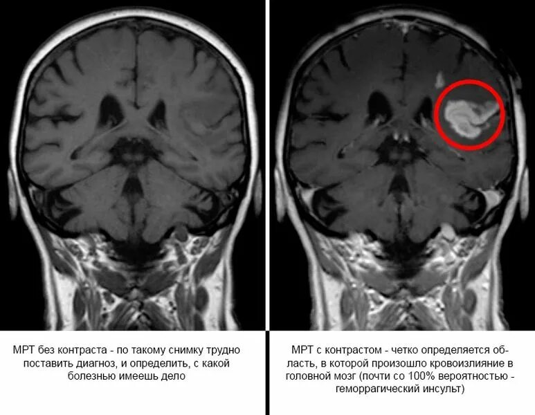 Что такое контрастирование при мрт головного мозга. Мрт с йодовым контрастом. Микроинсульт на мрт мозга. Кт томограмма головного мозга.
