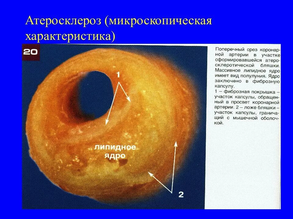 Заболевание сосудов термин. Классификация атеросклероза патанатомия. Классификация атеросклероза патанатомия. Стадии атеросклероза патологическая анатомия. Этиологические факторы атеросклероза.