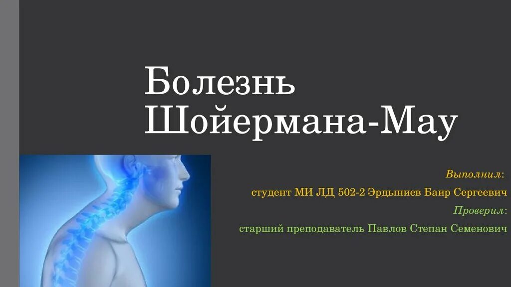 Болезнь шейермана мау что это такое. Болезнь Шойерманна-МАУ. Исход болезни Шойермана МАУ. Искривление позвоночника синдром Шейермана МАУ. Болезнь Шейермана МАУ грудного отдела позвоночника.