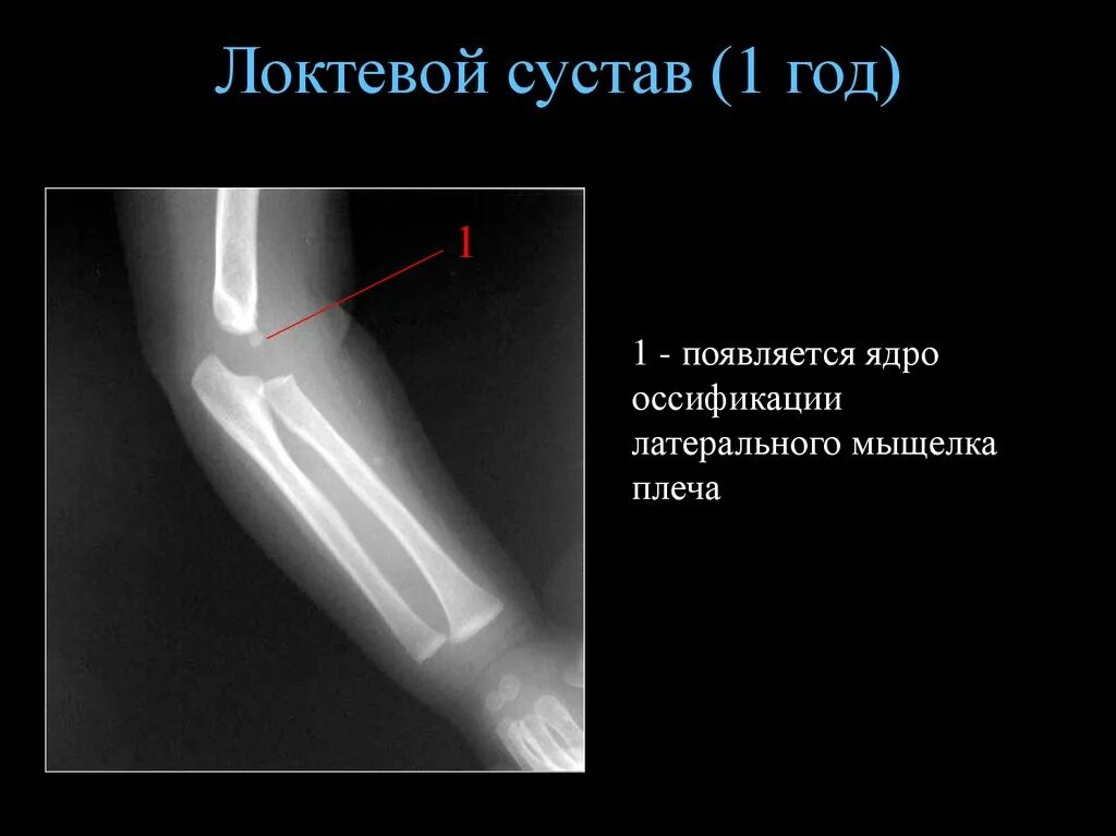 Локтевого мыщелка. Ядра окостенения локтевого сустава. Локтевой сустав рентген анатомия. Ядро окостенения локтевого отростка. Ядра окостенения локтевого сустава рентген.