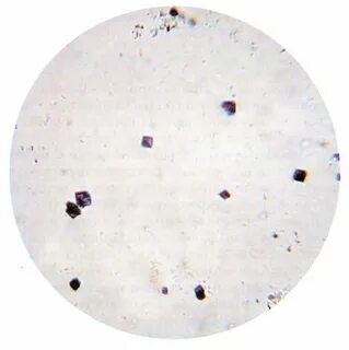 Как выглядит песок в моче