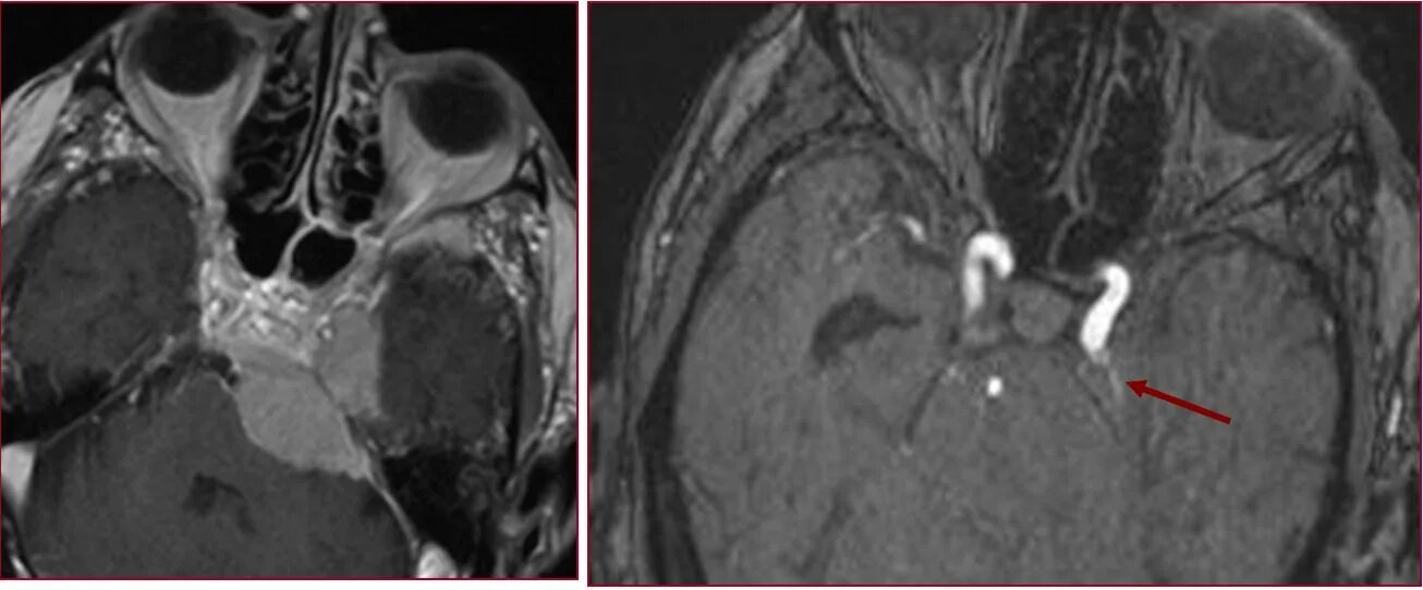 Тромбоз кавернозного синуса на кт. Тромбоз пещеристого синуса кт. Менингиома пещеристого синуса. Тромбоз на кт