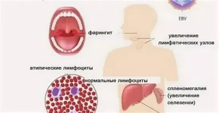 Инфекционный мононуклеоз патогенез схема. Инфекционный мононуклеоз у детей патогенез. Патогенез сыпи при мононуклеозе. Инфекционный мононуклеоз этиология. Этиология сыпей