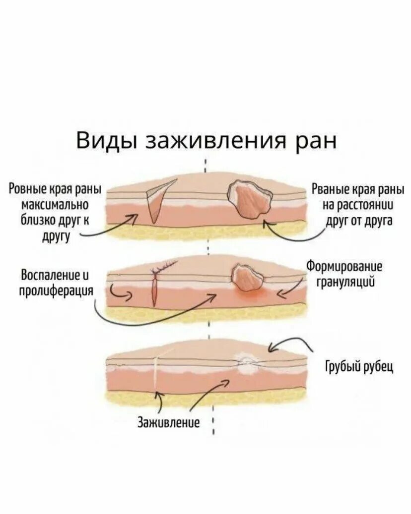 Этапы заживления ран. Схема процесса заживления раны. Стадии заживления РАН вторичным натяжением. Процесс заживления РАН схема. Первичное натяжение раны.