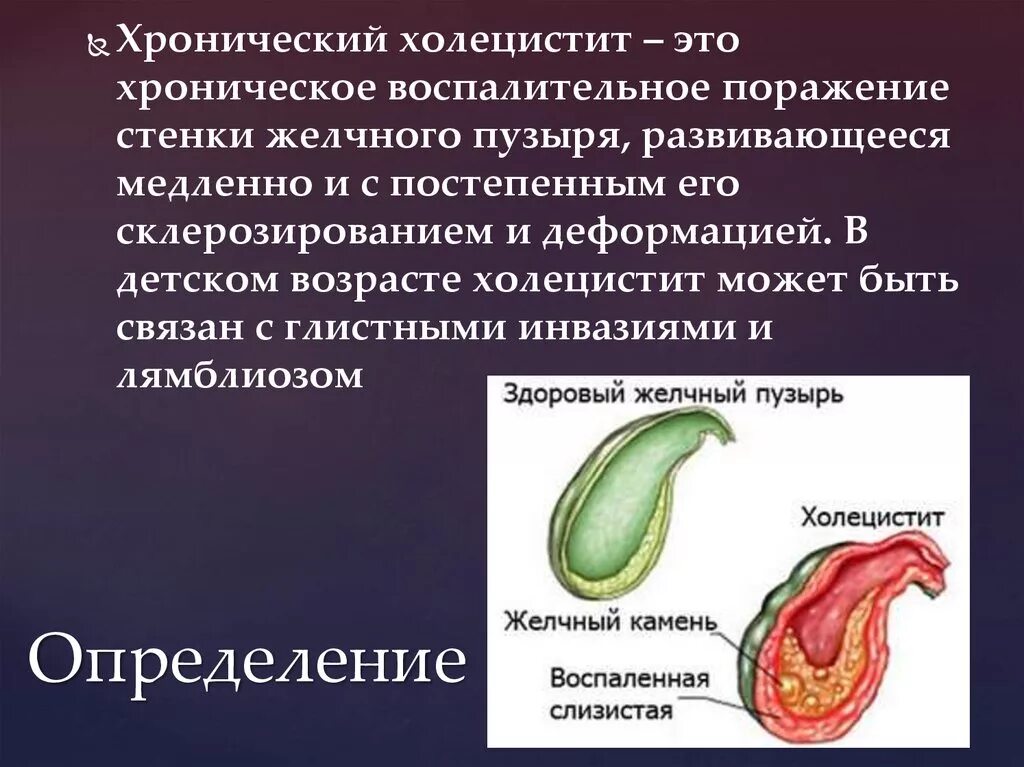 Слизистая оболочка желчного пузыря. Хронический холецистит. Холецистит желчного пузыря. Хронический холецистопанкреатит.