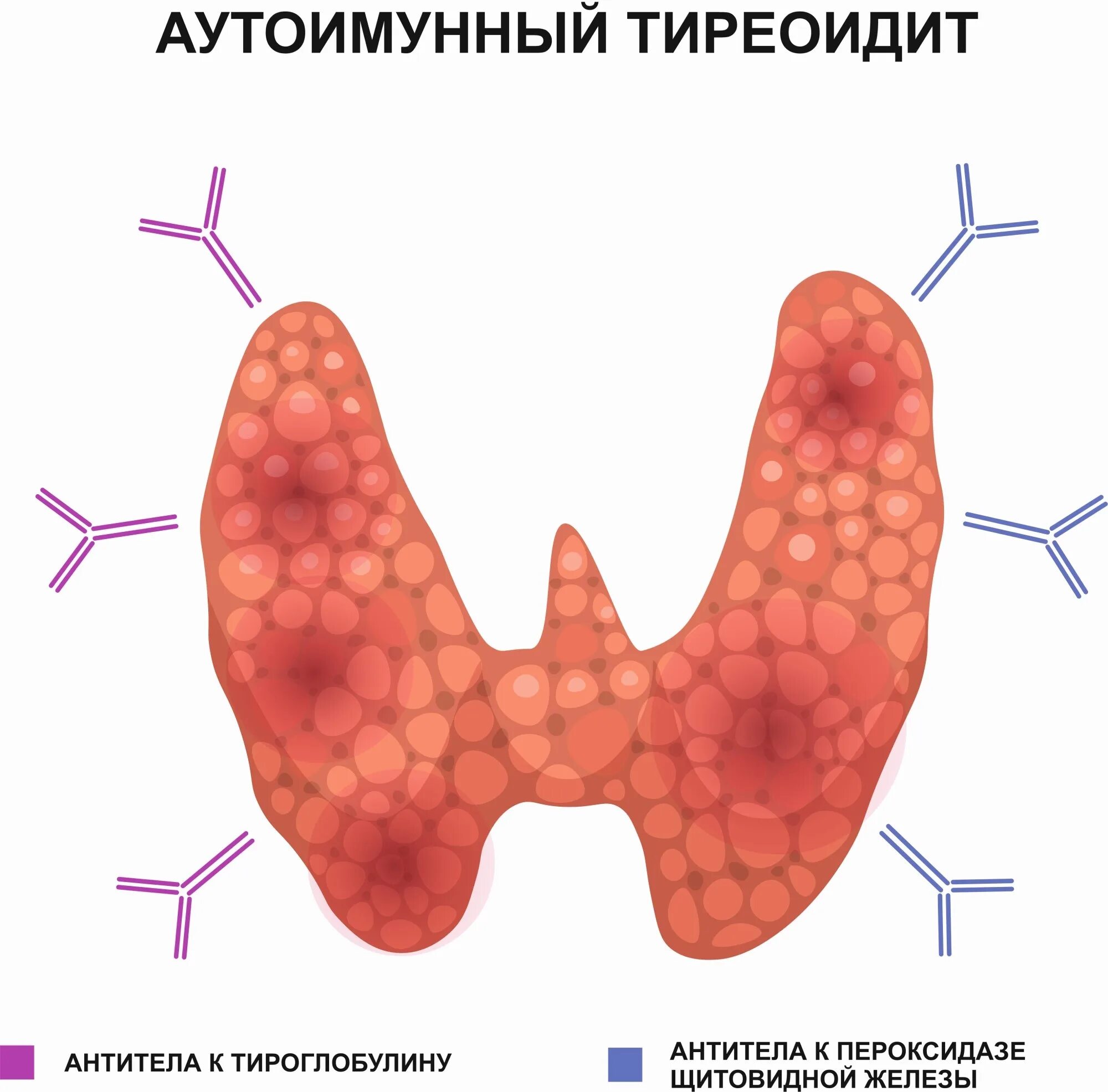 Зоб тиреоидит. Аутоиммунный тиреоидит Хашимото. Хронический аутоиммунный тиреоидит щитовидной железы. Аутоиммунный тиреоидит щитовидной железы что это такое. Тиреоидит Хашимото щитовидной.