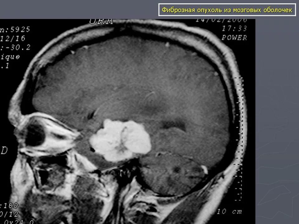 Доброкачественная опухоль головного мозга сколько живут. Доброкачественная опухоль оболочки головного мозга. Опухоли твердой мозговой оболочки.