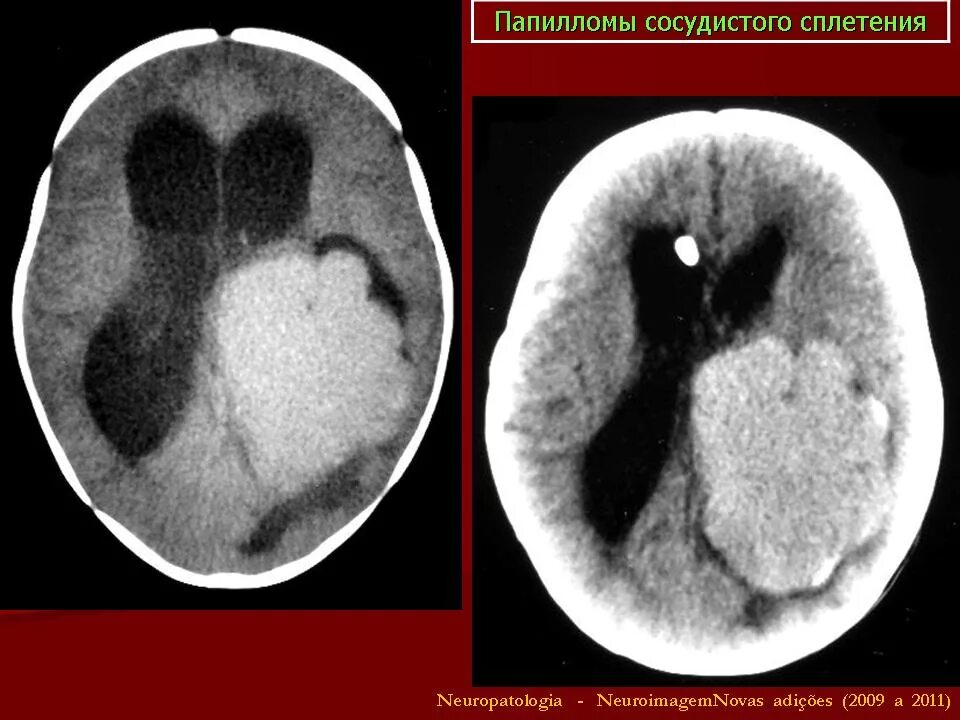 Опухоли желудочков. Хориоидпапиллома боковых желудочков. Хориоидная папиллома кт. Опухоли сосудистого сплетения.