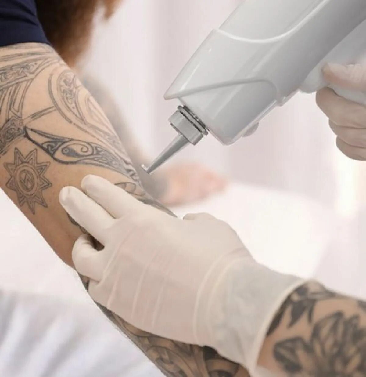 Удаление тату неодимовым. Удаление татуировок лазером. Косметическая Татуировка. Лазерное оборудование для удаления тату.