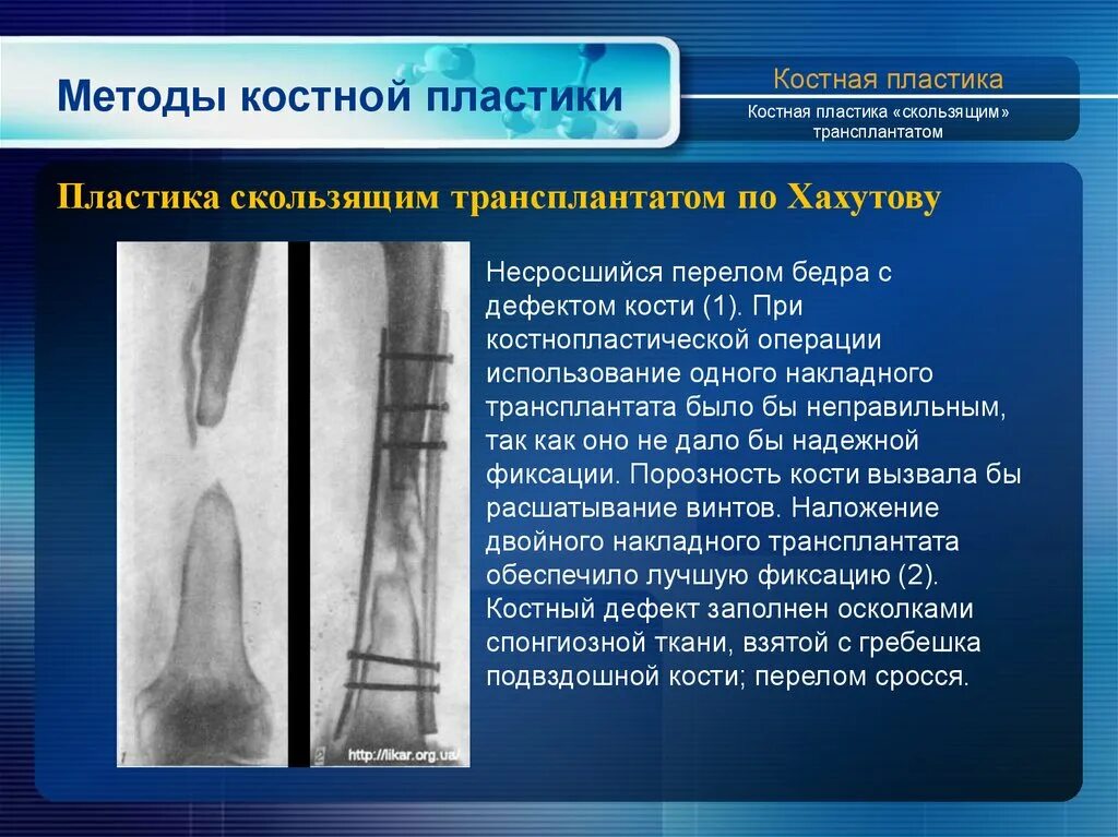 Пересадка кости. Способы костной пластики. Костная пластика скользящим трансплантатом. Методика костной пластики. Костная пластика скользящим трансплантатом по Хахутову.