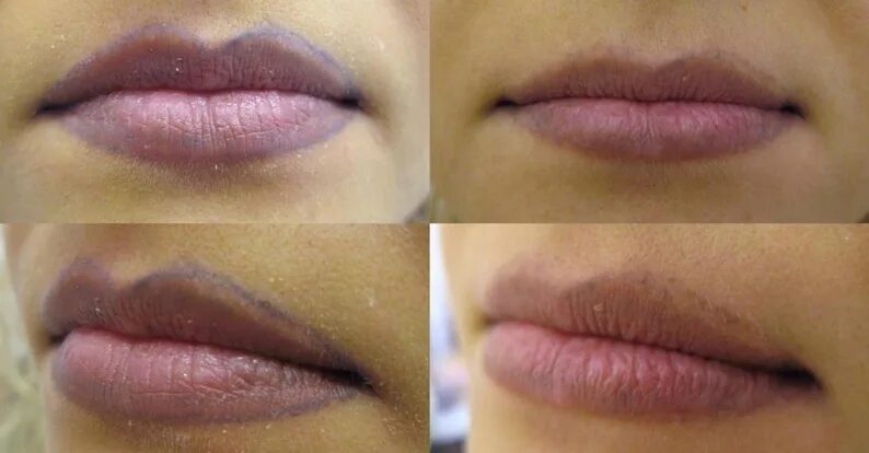 Лазер губы. Лазерное омоложение губ. Заживлен е губ после ремувера. Татуаж губ после лазера. Лазер губы.