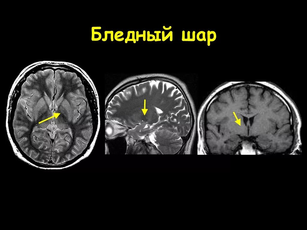 Анатомия головного мозга таламус кт. Хвостатое ядро мозга кт. Мрт головного мозга фронтальный срез. Базальные ядра кт анатомия. Изменение в базальных отделах