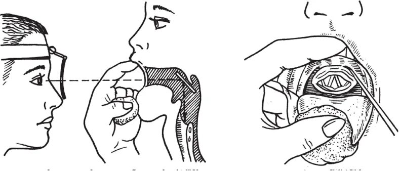 Гортань непрямая ларингоскопия. Гортань не прямая ларингоскопия. Ларингоскопия гортани схема. Ригидная ларингоскопия. Глотка лор