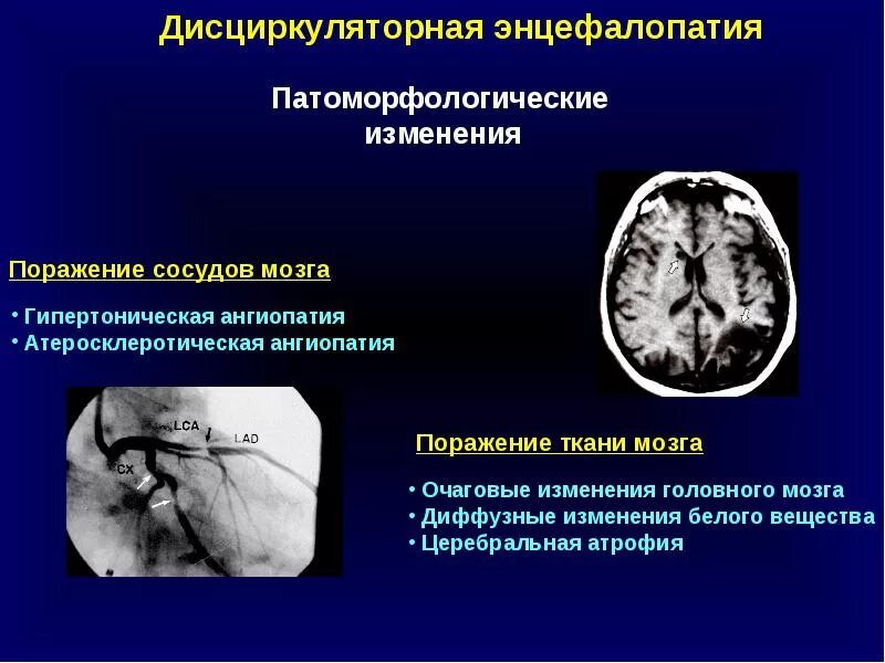 Дисциркуляторная энцефалопатия мрт. Гипертоническая энцефалопатия мрт. Дисциркуляторная энцефалопатия стадии мрт. Дисциркуляторная энцефалопатия головного мозга на кт. Диффузная церебральная