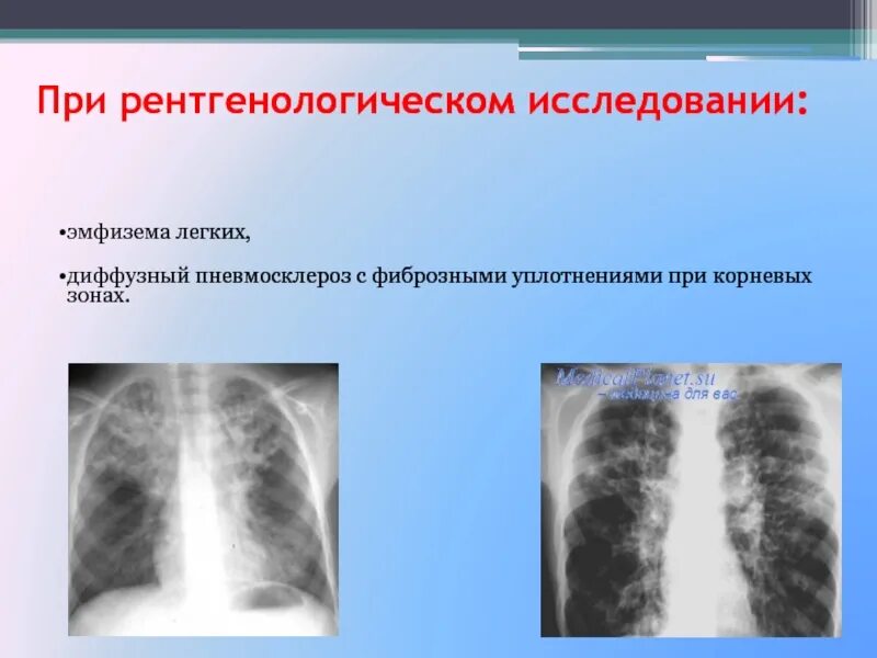 Диффузная пневмосклероз у пожилых. Пневмосклероз легочной ткани. Постпневмонический пневмосклероз. Посттуберкулёзный пневмосклероз. Диффузный пневмосклероз рентген.