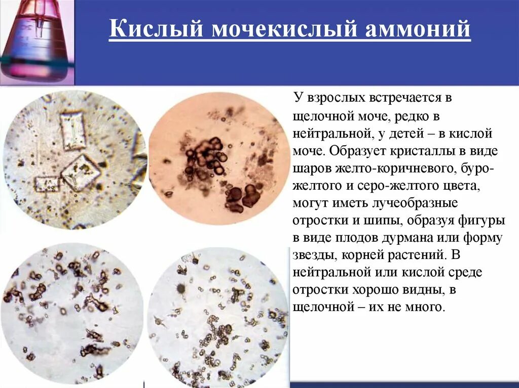 Высокая соль в моче. Соли в кислой моче микроскопия. Кислый мочекислый аммоний. Кристаллы мочекислый аммоний в моче. Кислый мочекислый аммоний в моче.