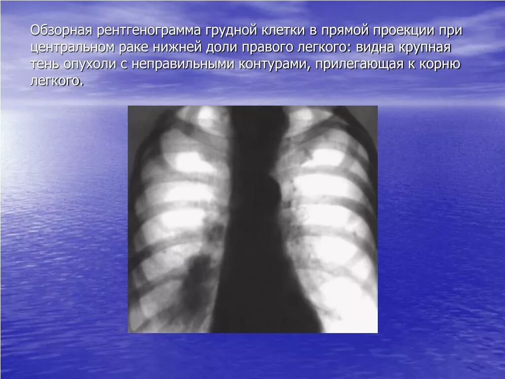 Рак нижней доли. Опухоли плевры рентген. Обзорная рентгенограмма грудной клетки. Заболевания легких на рентгене. Рентгенограмма легких в прямой проекции.