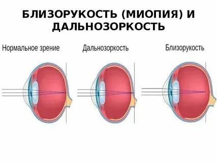 Из за близорукости перепутал