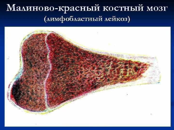 Печени и костного мозга. Хронический миелолейкоз костный мозг макропрепарат. Лейкоз костного мозга макропрепарат. Пиоидный костный мозг при лейкозе. Лейкоз красный костный мозг гистология.