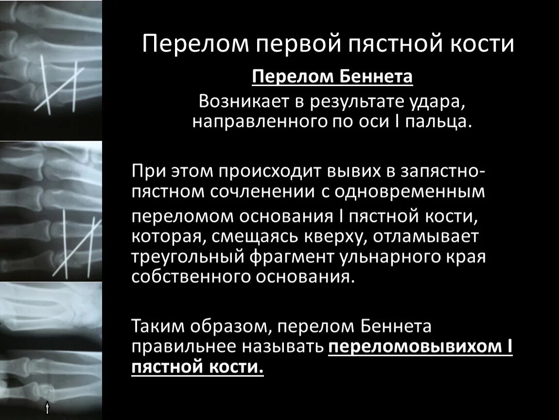 Переломовывих Беннета рентген. Перелом основания 1 пястной кости («перелом Беннета»). Перелом основания 1 пястной кости. Репозиция при переломе основания первой пястной кости.