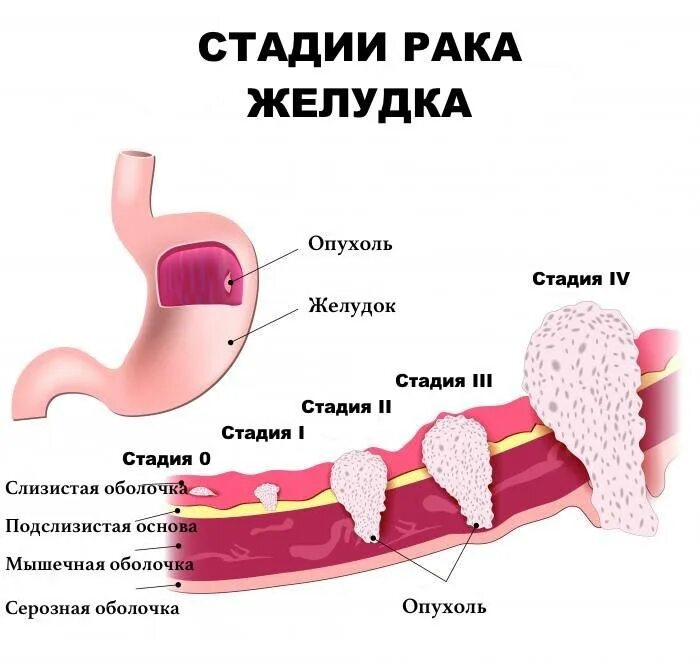 Как определить стадию рака желудка. Стадии гастрита желудка.