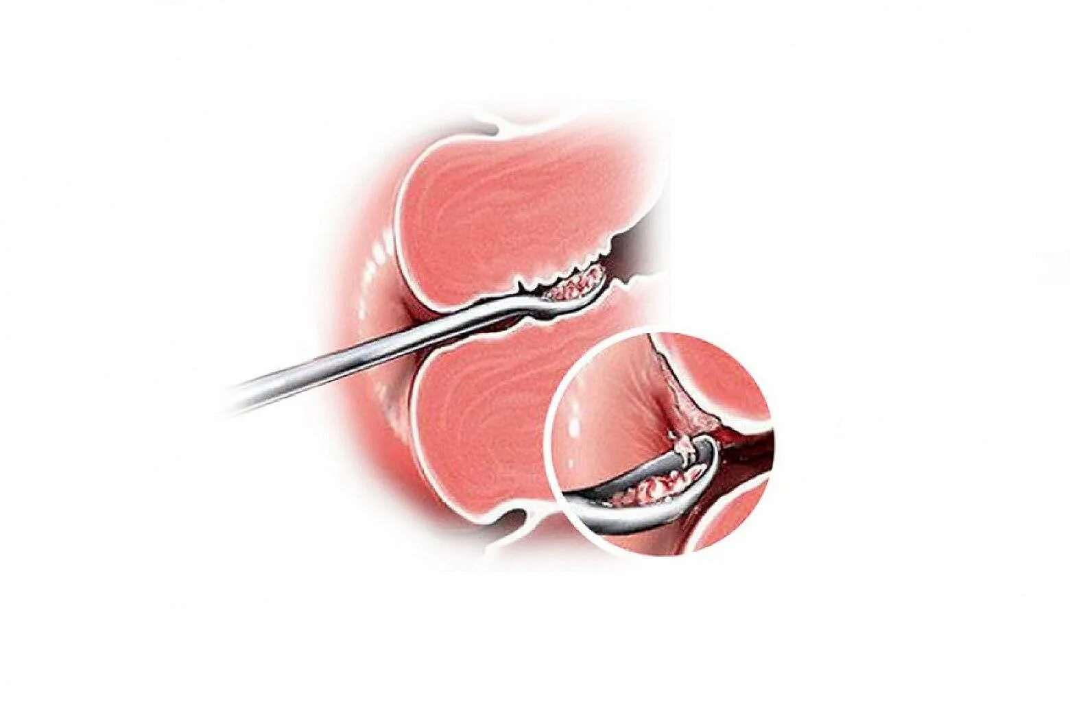 Как называется выскабливание. Выскабливание цервикального канала шейки. Хирургическое выскабливание полости матки. Бужирование цервикального канала. Инструменты для бужирования цервикального канала.