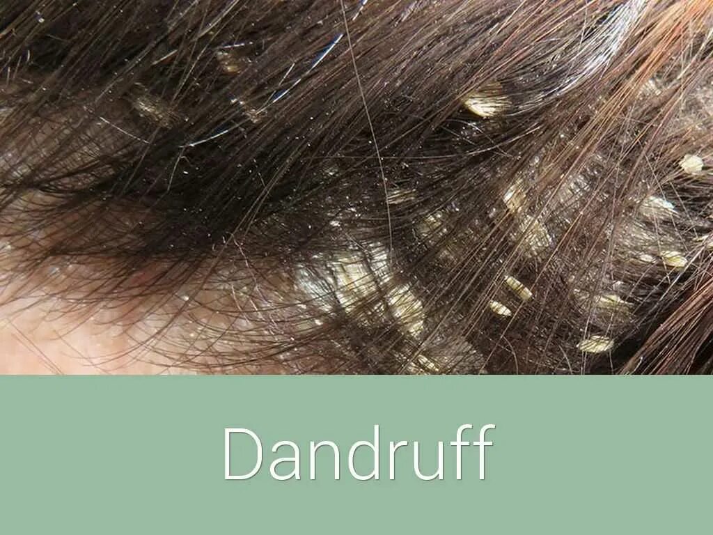 Луковая перхоть. Луковая перхоть. Псориаз кожи головы против перхоти. Луковая перхоть. Луковая перхоть.