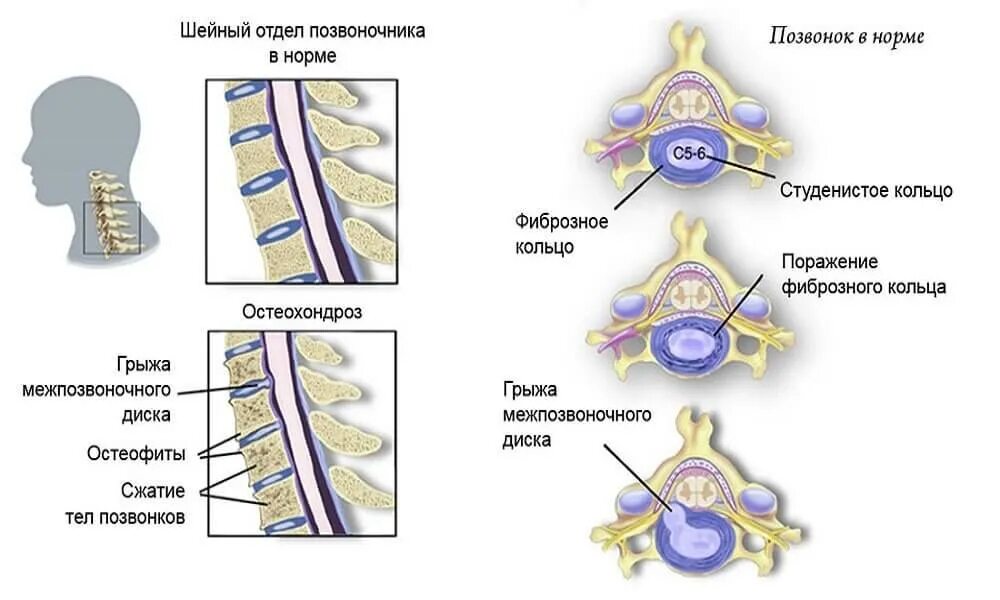 Спинной форум. Шейный отдел позвоночника шейный отдел позвоночника анатомия. Остеохондроз 1-2 позвонка шейного отдела позвоночника. Грыжа шейного отдела позвоночника. Шейный остеохондроз позвонки шейного отдела.