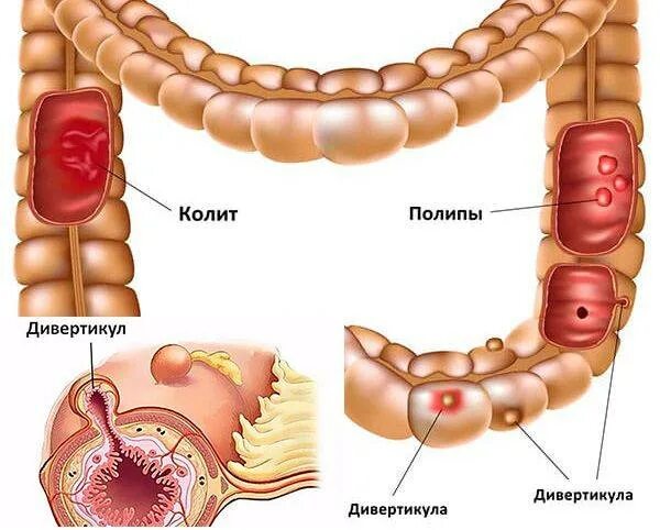 Что такое дивертикулез. Дивертикулярной болезни толстого кишечника. дивертикулез дивертикулит толстой кишки. дивертикул толстой кишечника. дивертикулёз сигмовидной кишечник.