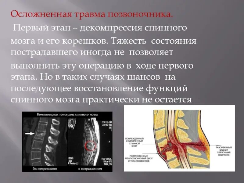 Повреждение позвоночника и спинного мозга. Осложненная травма позвоночника. Травматические повреждения спинного мозга.