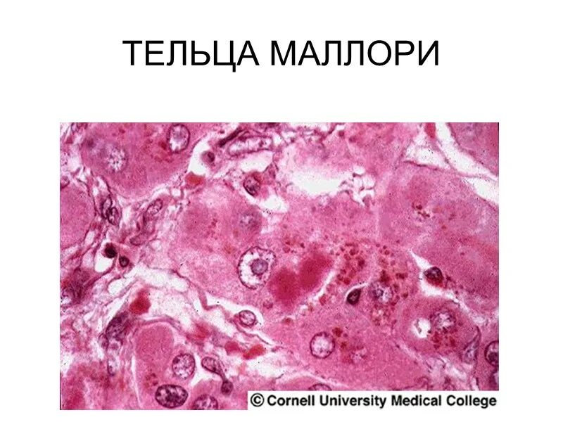 Тельца мэллори. Тельца мэллори гистология. алкогольный гепатит тельца маллори. тельца маллори гистология. алкогольный гепатит гистология тельца маллори.