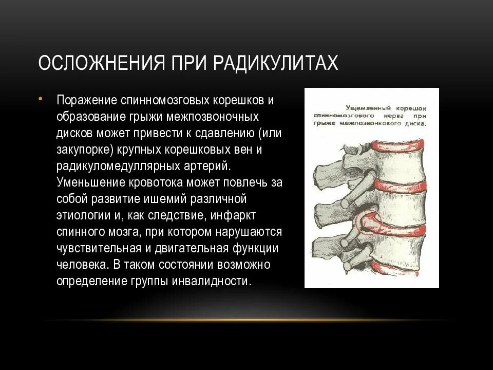 Поражение корешковых нервов. Поражение межпозвоночных дисков с радикулопатией. Осложнения пояснично крестцового радикулита. Сдавление корешка грыжей диска.