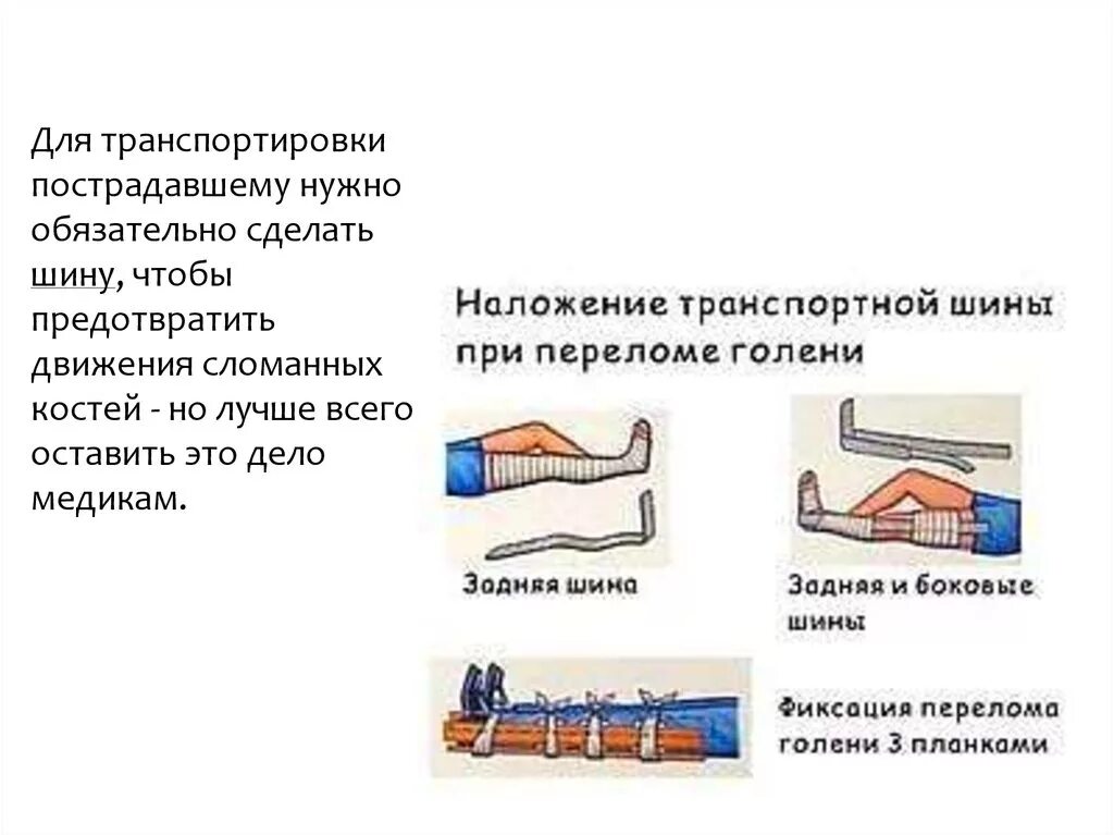 Кровотечение при открытом переломе голени. Наложение шины при переломе. Шина при переломе голени. Наложение транспортной шины при переломе голени.