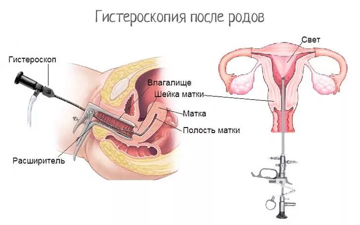 Сколько выделения после выскабливания матки. Выскабливание эндометрия. Гиперплазия эндометрия гистероскопия. Гистероскопия после родов.
