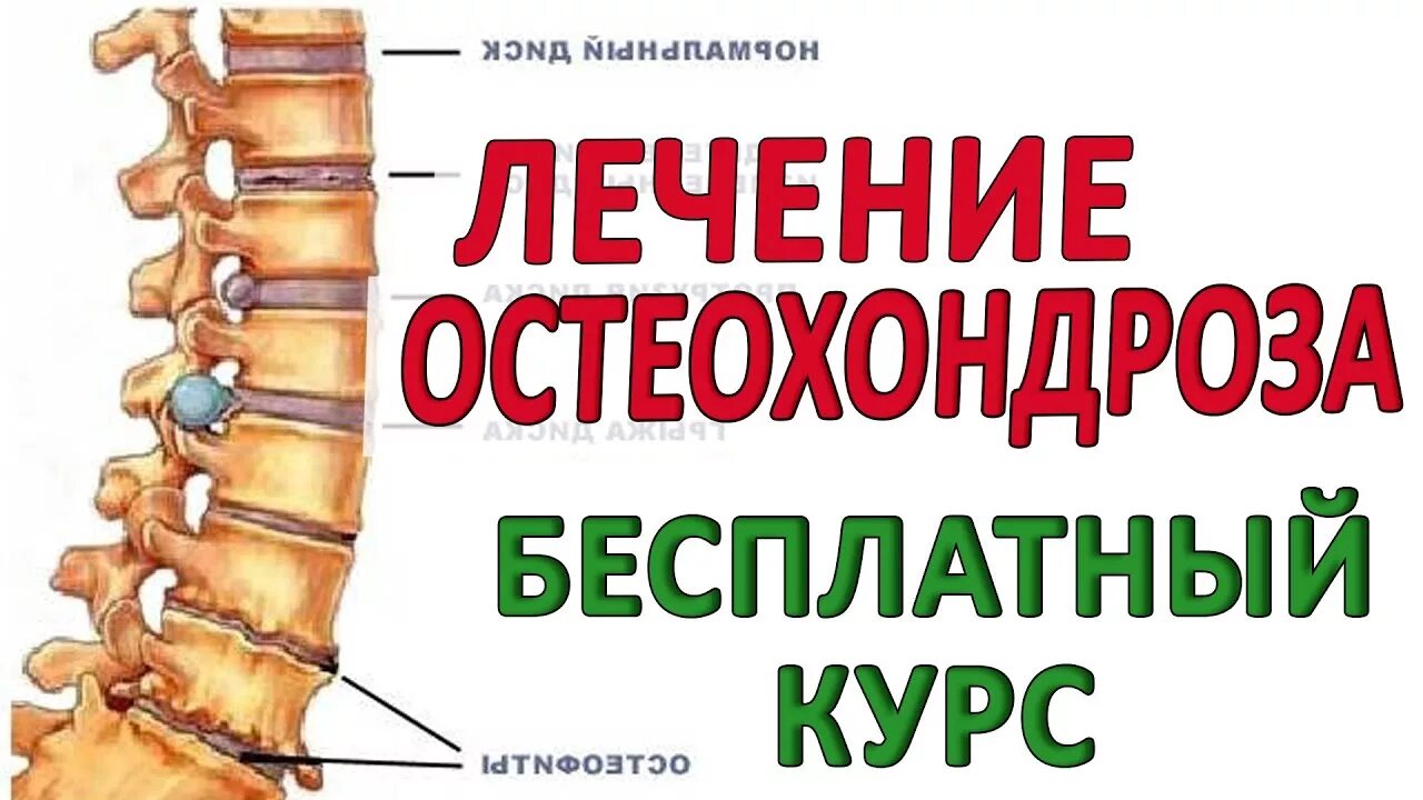 Как лечить поясничного отдела позвоночника. Остеохондроз. Остеохондроз шейного отдела. Остеохондроз поясничного отдела. Остеохондроз позвоночника.