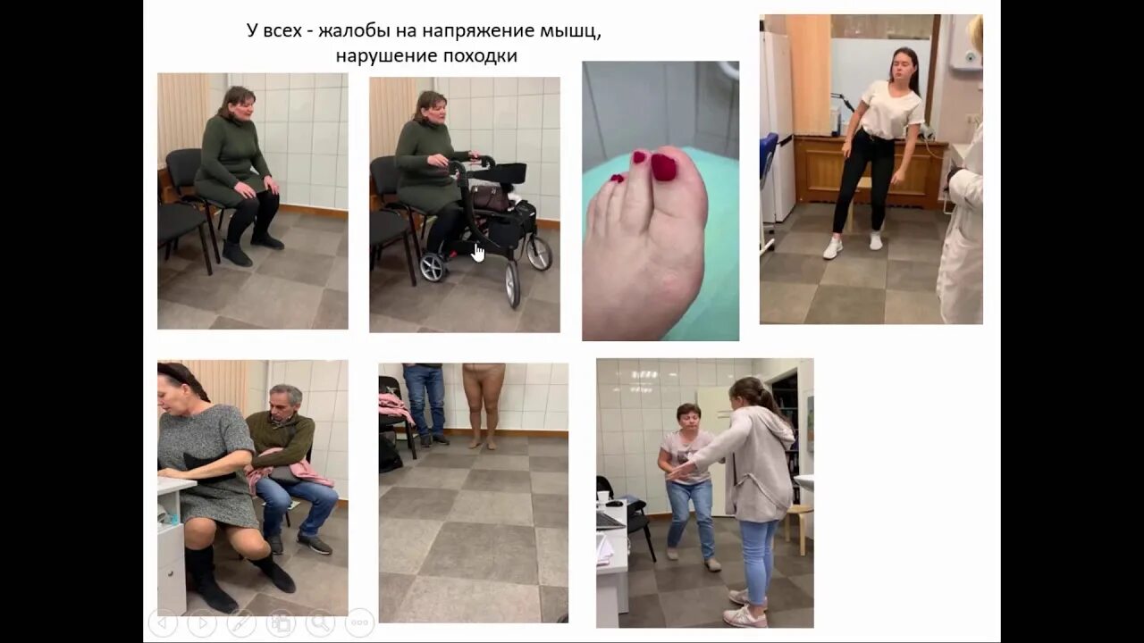 Акинетико-ригидный синдром симптомы. Антитела к рецепторам инсулина. Акинетико-ригидный синдром симптомы. Синдром ригидного человека. Синдромы поражения экстрапирамидной системы таблица.