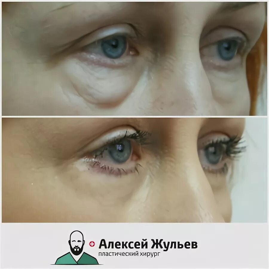 Блефаропластика в оренбурге фото