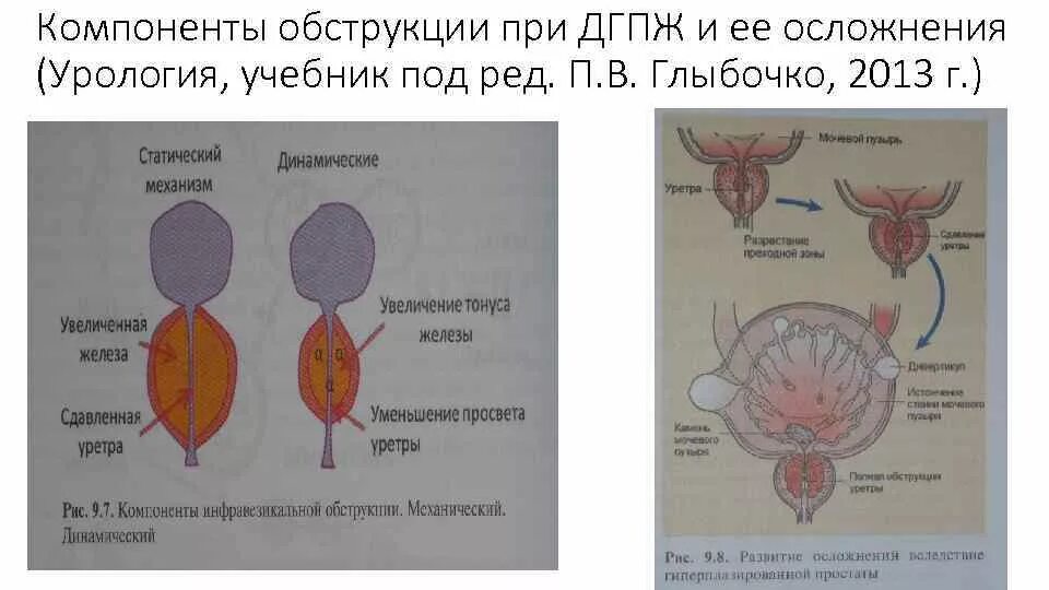 При гиперплазии предстательной железы. Доброкачественная гиперплазия предстательной железы осложнения. При доброкачественной гиперплазии предстательной железы применяют. Гиперплазия предстательной железы 1